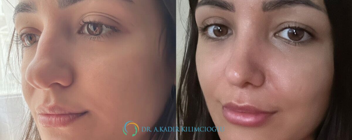 What Is a Bifid (Split) Nasal Tip?